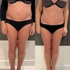 Résultat cryolipolyse sur femme