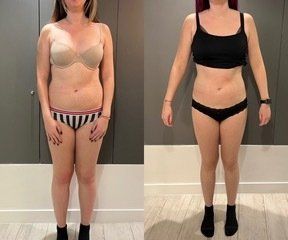 Résultat cryolipolyse