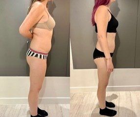 Résultat cryolipolyse vue de côté