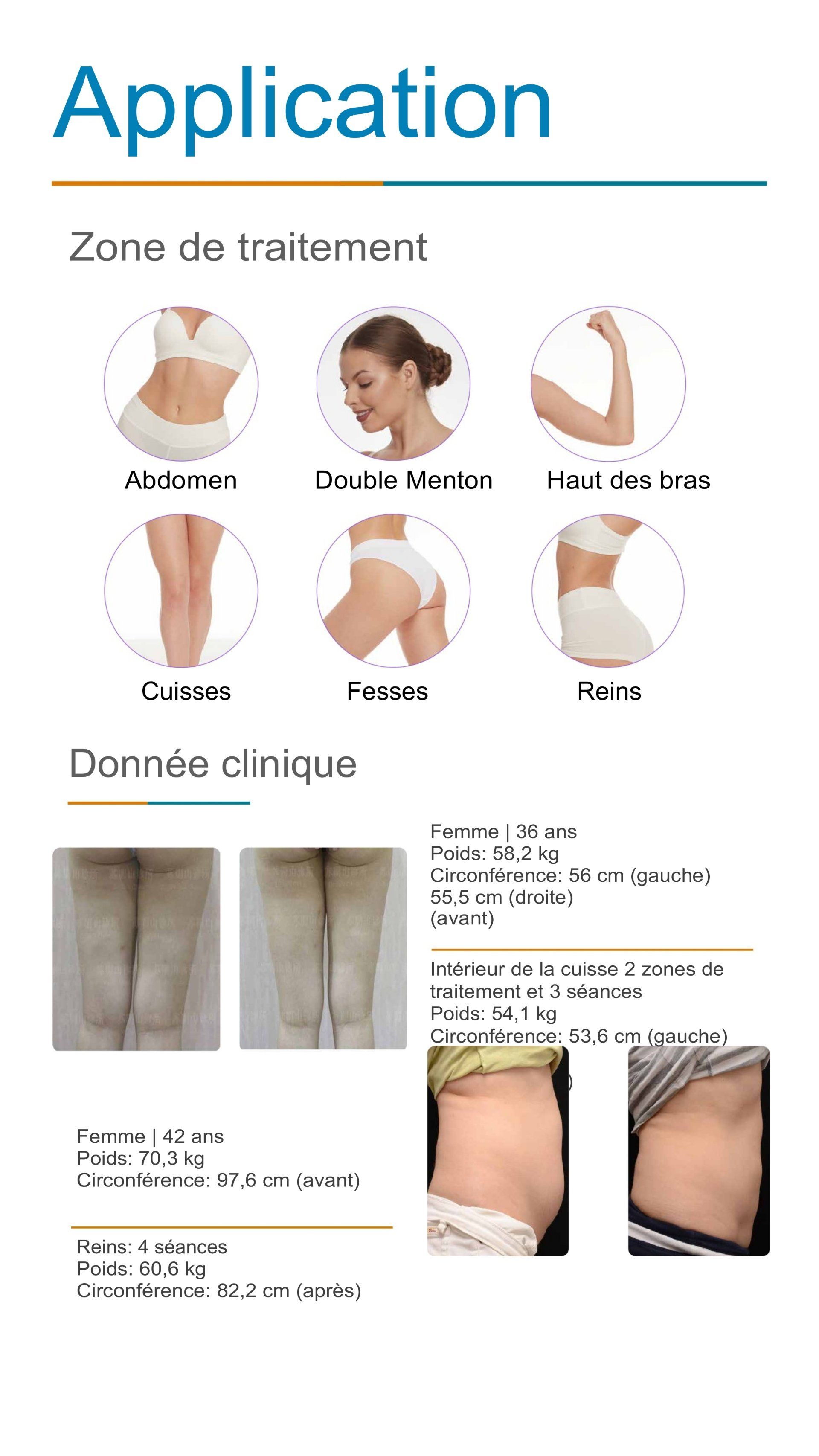 Les applications de la cryolipolyse