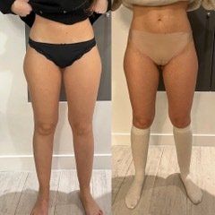 Cryolopolyse ventre et jambe femme