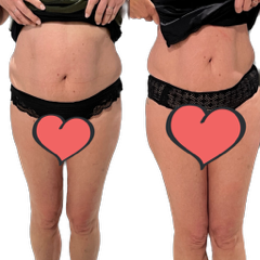 Rendu cryolopolyse sur femme vue de face