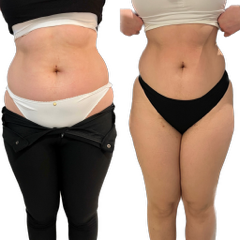 Rendu cryolopolyse vue de face