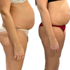 Cryolopolyse ventre et cuisse