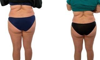 Cryolopolyse pour femme