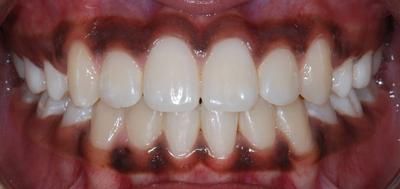 1 face après - Cabinet d'orthodontie Epars - Chiarini - Montreux