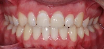 2 face après - Cabinet d'othodontie Epars - Montreux