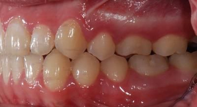 2 droite après - Cabinet d'othodontie Epars - Montreux