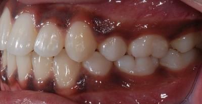 1 droite après - Cabinet d'orthodontie Epars - Chiarini - Montreux