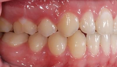 2 gauche après - Cabinet d'othodontie Epars - Montreux