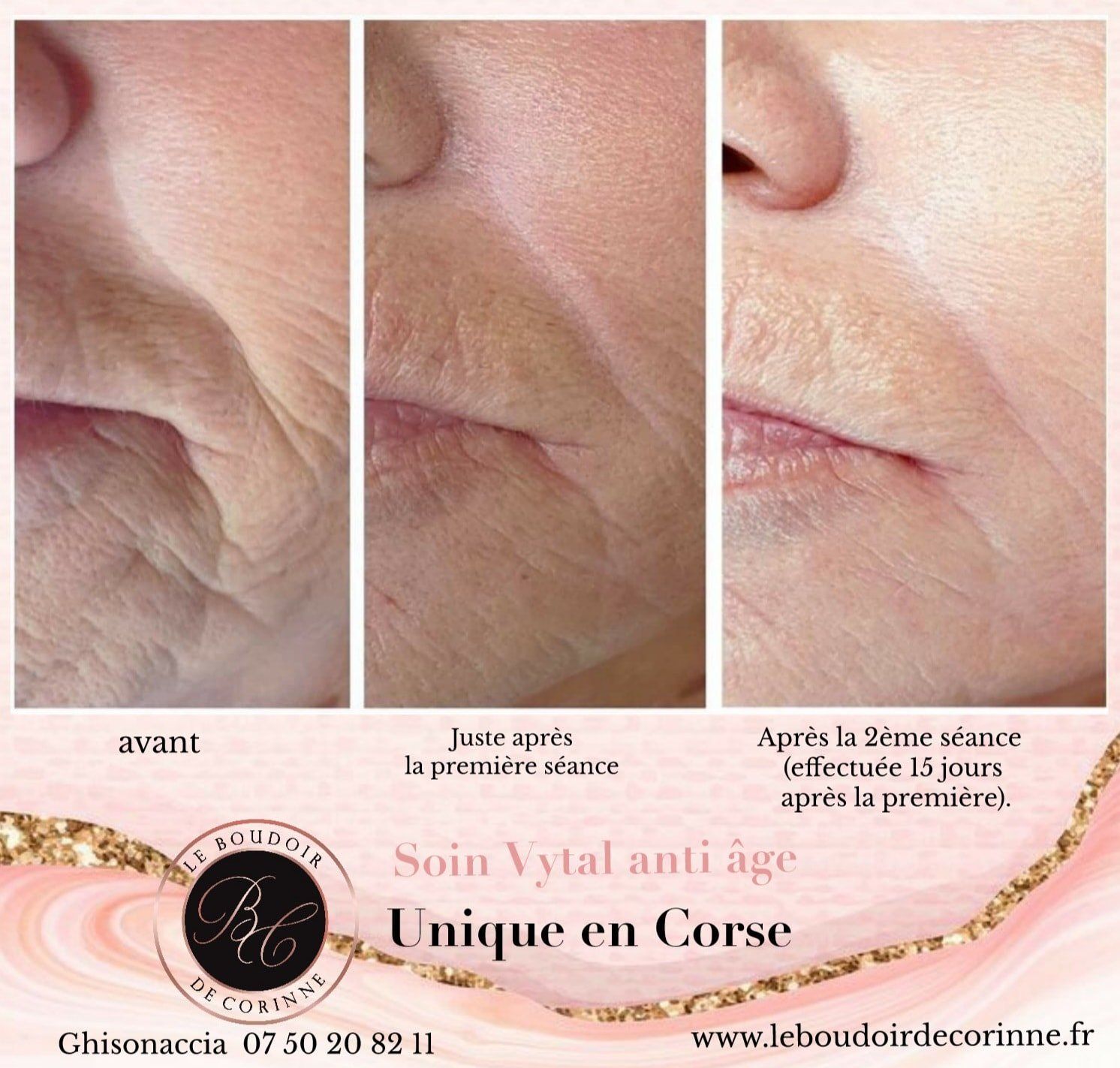 avant/ après Soin Vytal autour de la bouche