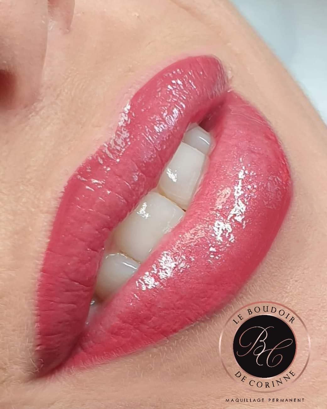 Grand angle bouche permanent