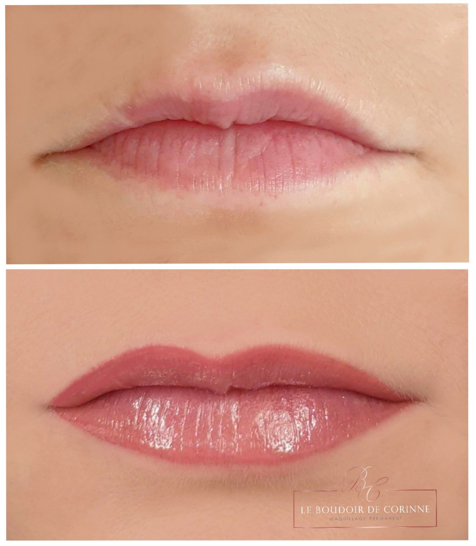 photo face avant/ après bouche permanente