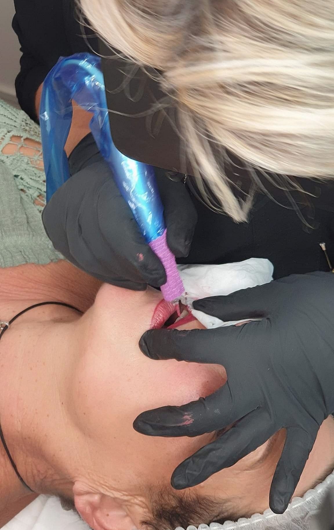 PIgmentation sur les lèvres