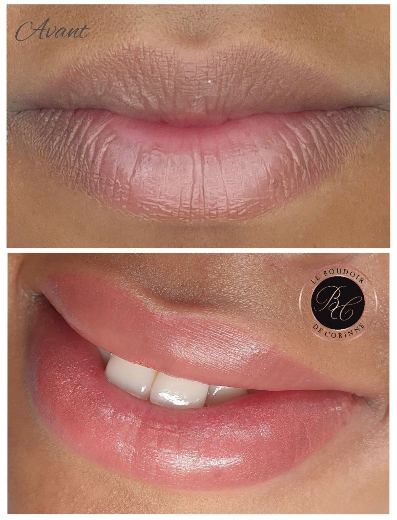 Légère pigmentation des lèvres sur peau matte