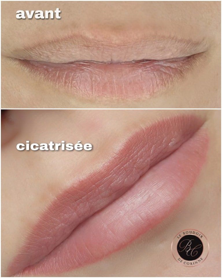 avant/ après bouche permanente cicatrisée