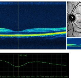 Kohärenztomografie - Augenarztpraxis am Stampfenbachplatz - Zürich