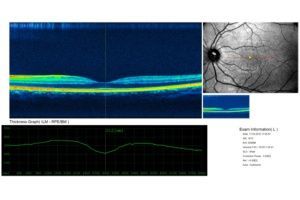 Makuladegeneration - Augenarztpraxis am Stampfenbachplatz - Zürich