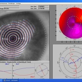 Hornhauttopografie - Augenarztpraxis am Stampfenbachplatz - Zürich