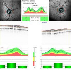 Normale Kohärenztomografie - Augenarztpraxis am Stampfenbachplatz - Zürich