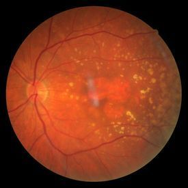 Makuladegeneration - Augenarztpraxis am Stampfenbachplatz - Zürich