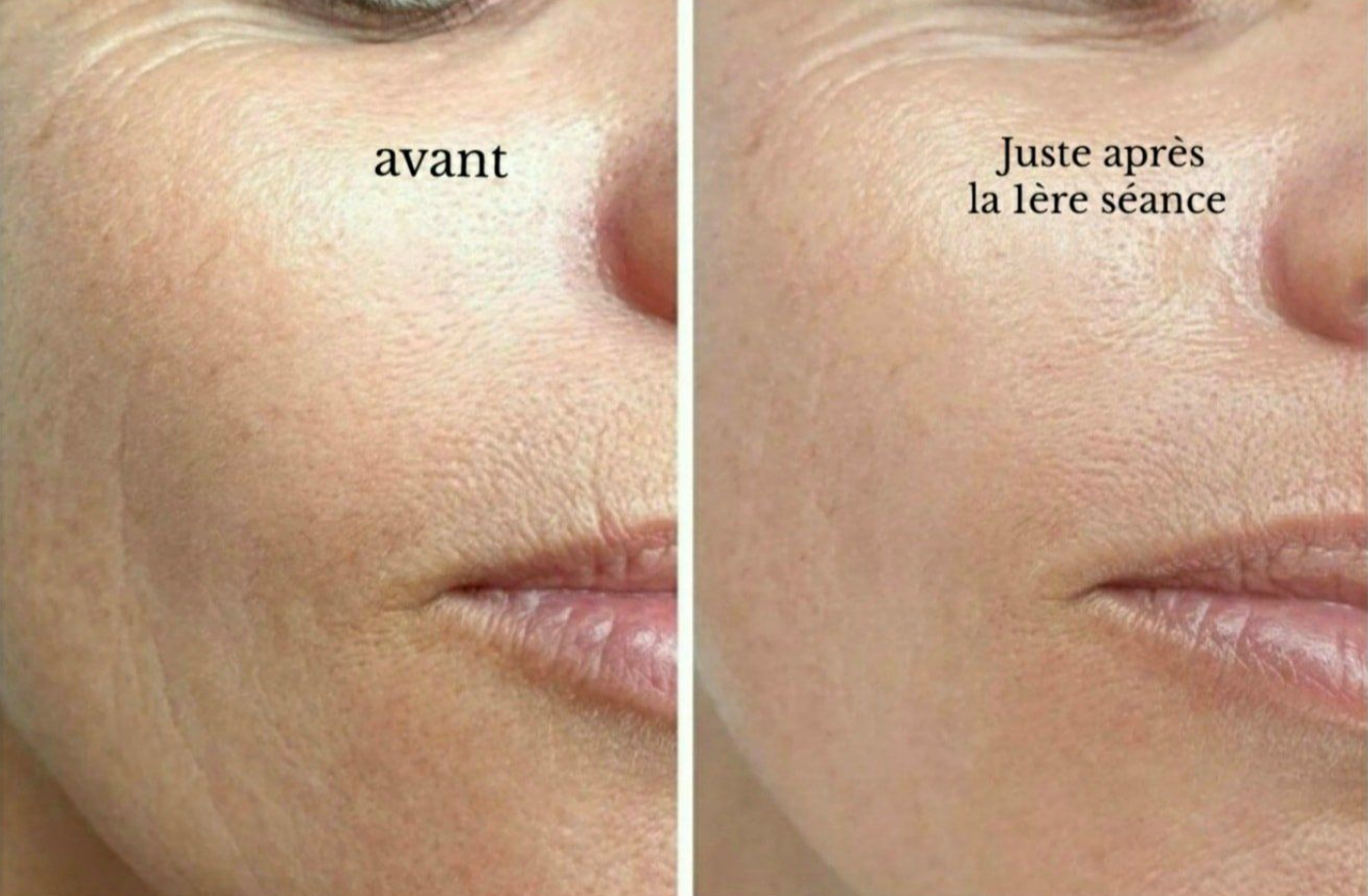 Comparaison rapprochée de la peau côte à côte, avec la mention « avant » et « juste après la première séance ».