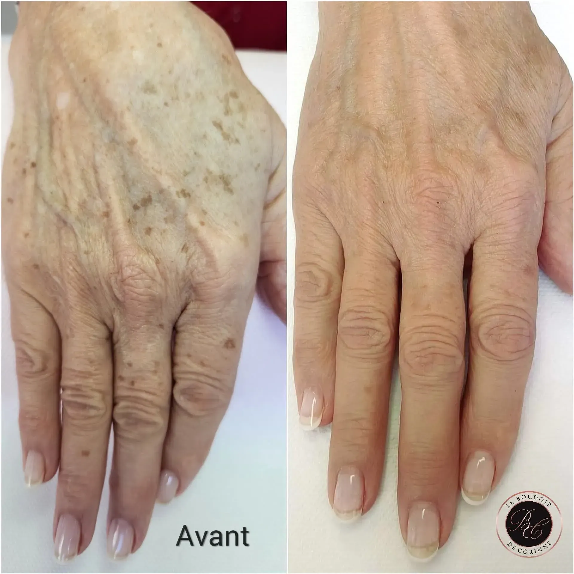 Lèvres après un maquillage permanent avec un pigment rouge