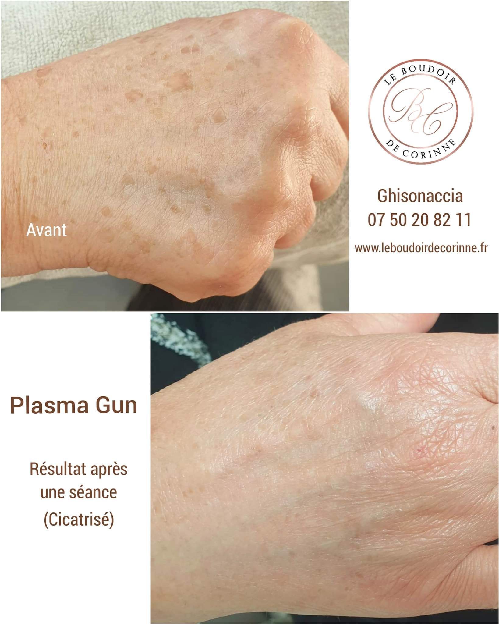 Photos avant et après traitement d'une main au pistolet plasma. La décoloration de la peau est visiblement réduite.