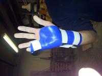 Attelle statique pour fracture du 5ème métacarpe