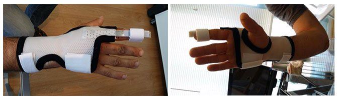 Attelle dynamique pour extenseur de doigts ( ici l'index )