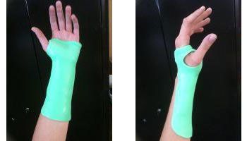 Attelle statique de poignet