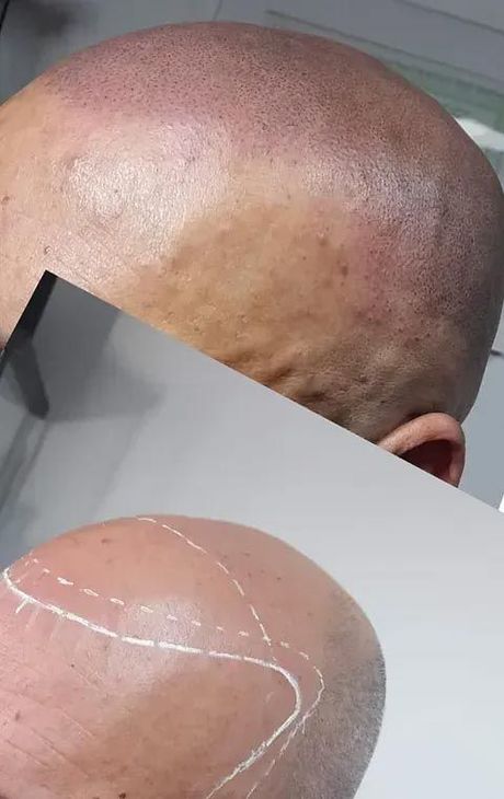 Hombre con micropigmentación capilar