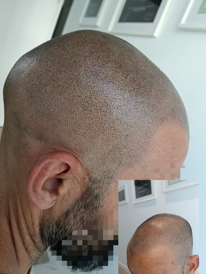 Se muestra a un hombre con la cabeza rapada desde diferentes ángulos.
