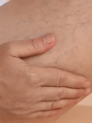Un primer plano de la mano de una persona en una pierna con venas varicosas.