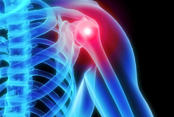 Klemmueinkenni í öxl (Impingement syndrome)