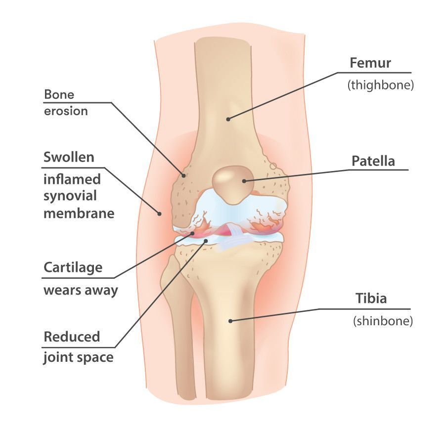 Proximal effects of unloader bracing for medial knee osteoarthritis – analyses of muscle activation and movement patterns at the hip during walking.