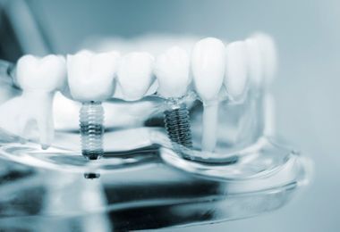 Un primer plano de un modelo de dientes con un implante dental.