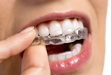 Una mujer se está colocando un aparato transparente en los dientes.