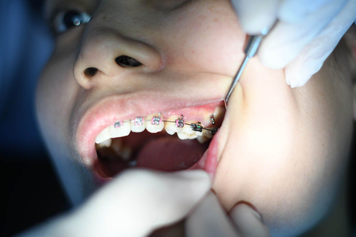 Dentiste vérifiant l'appareil dentaire d'un patient
