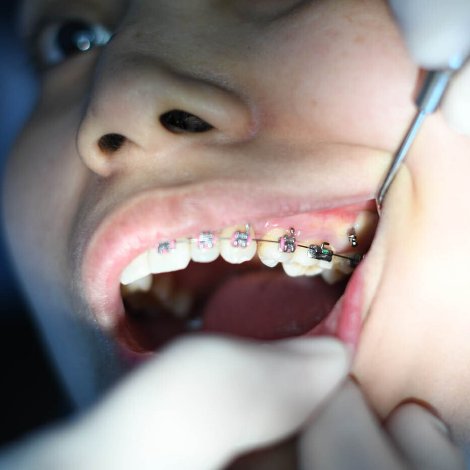 Dentiste vérifiant l'appareil dentaire d'un patient