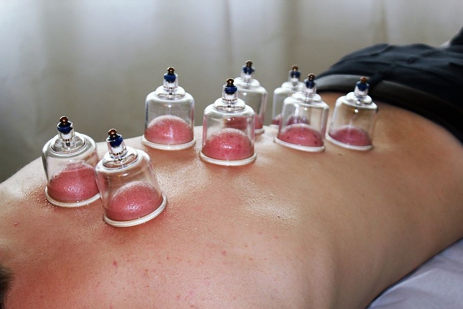 Schröpftherapie - Naturheilkundezentrum - Heiden