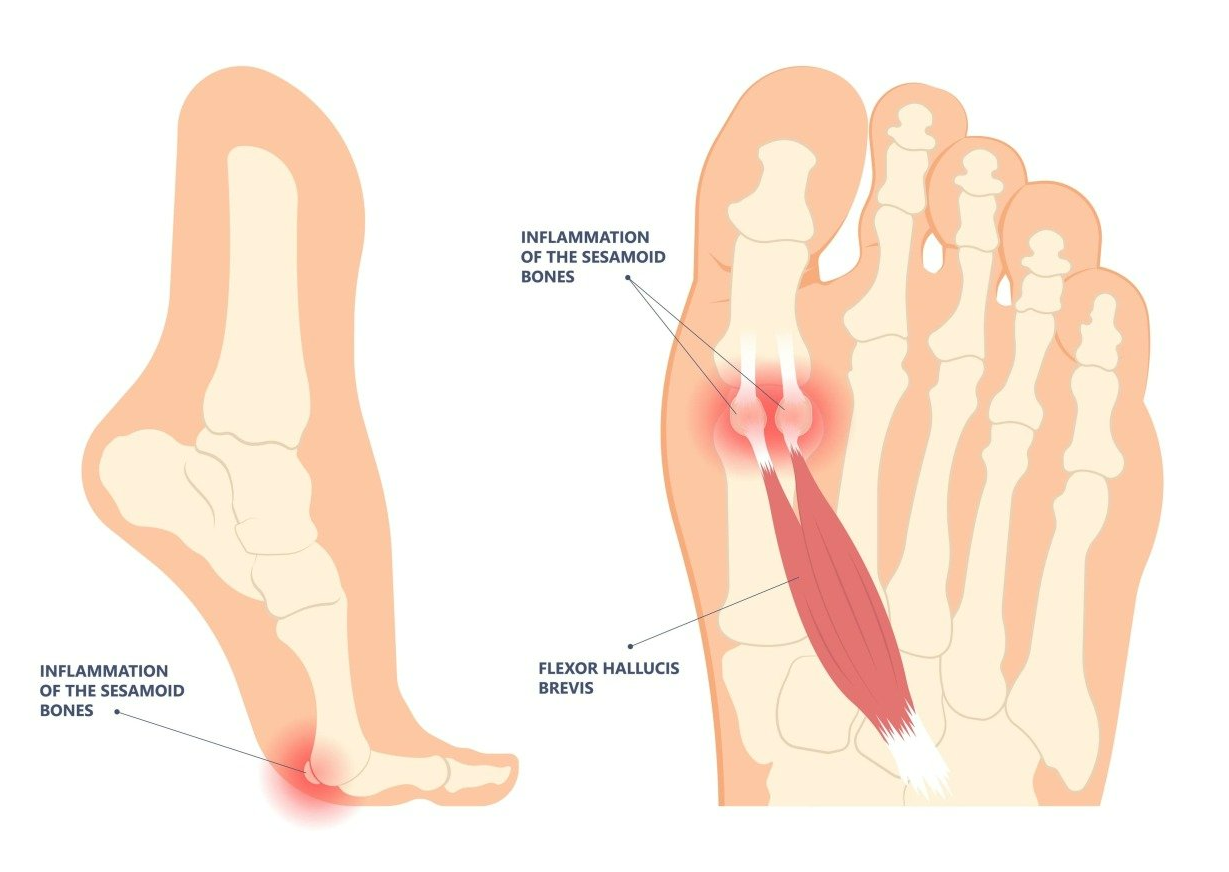 Schéma de blessure au pied