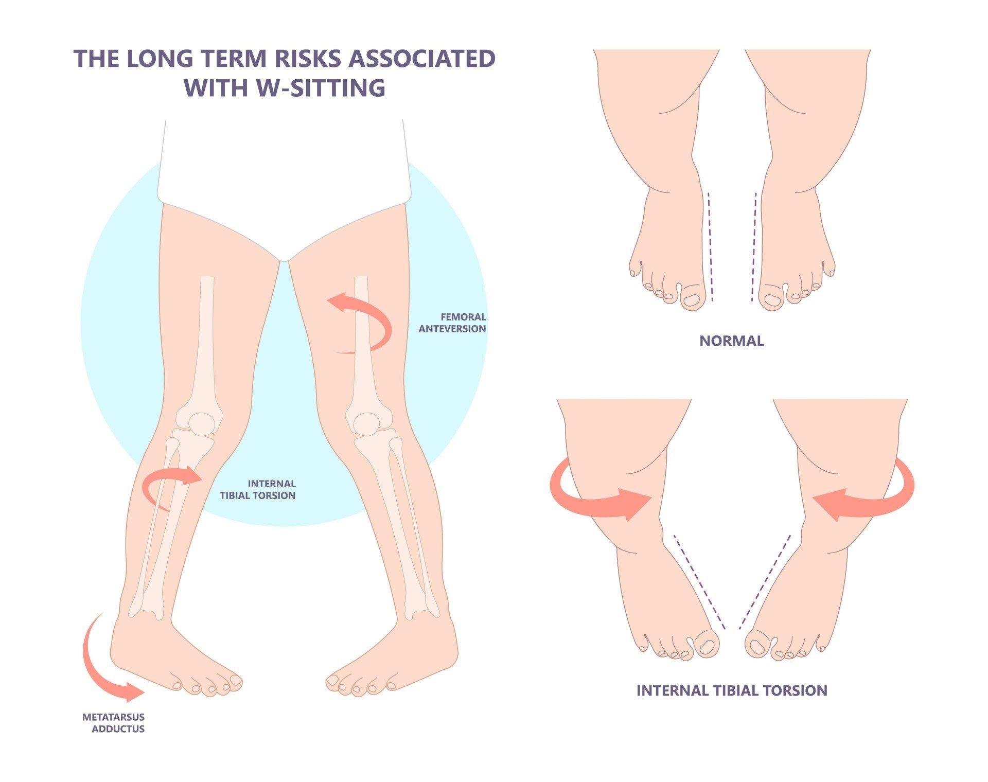 Schéma de jambe en W