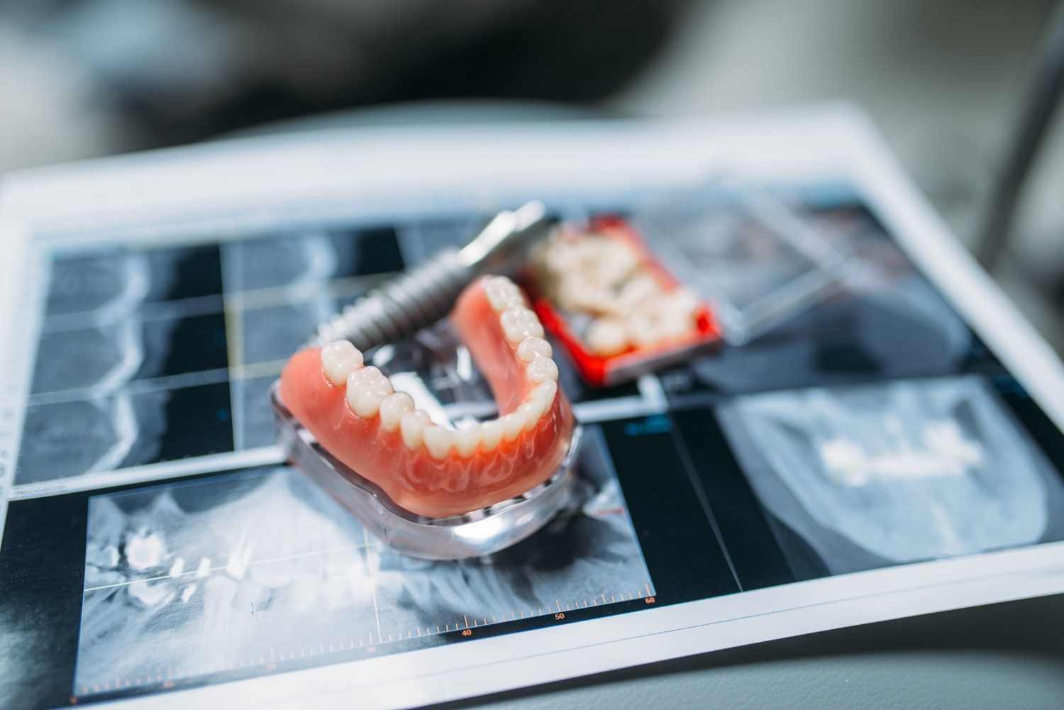 Modelo dental con aparatos de ortodoncia en radiografías.