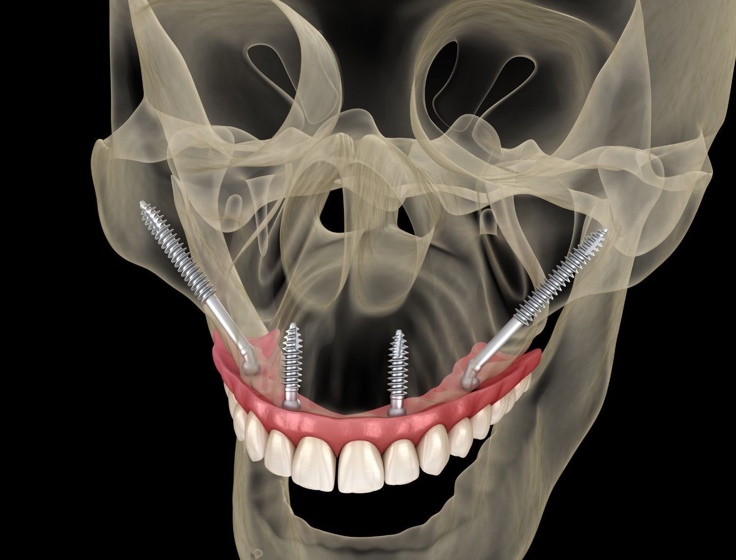 Radiografía dental 3D que muestra implantes en la mandíbula inferior y una hilera de dientes frontales.