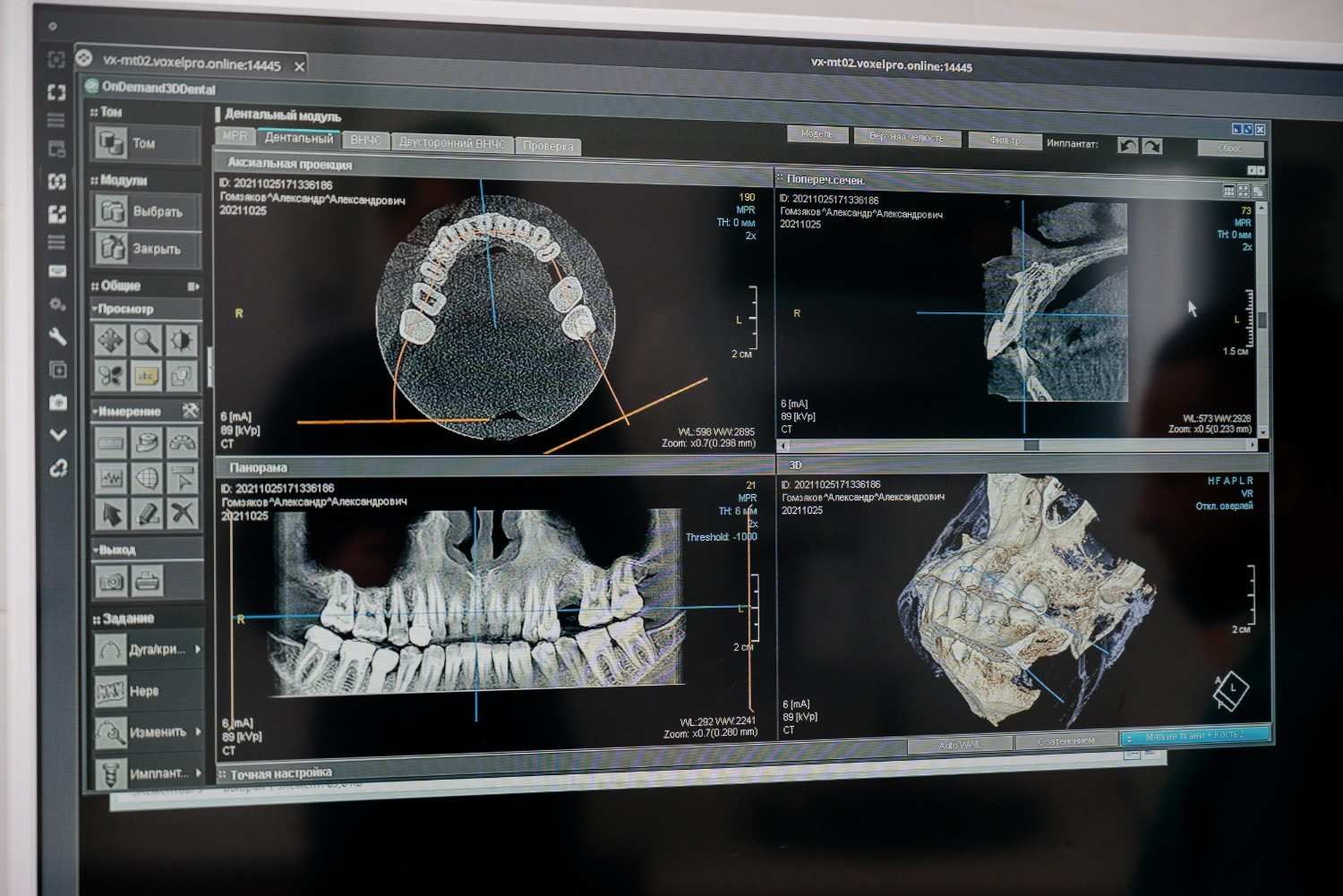 Software de imágenes dentales que muestra un escaneo 3D de la mandíbula y múltiples vistas de tomografía computarizada en un monitor.