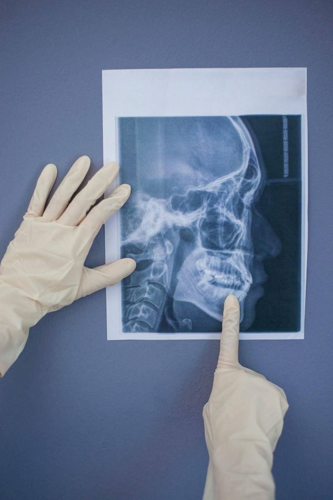 Hands holding and pointing to a side-view X-ray film of a skull on a blue background