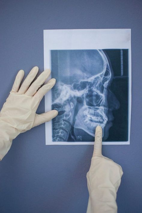 Manos enguantadas que sostienen y señalan una radiografía de cráneo sobre un fondo azul.