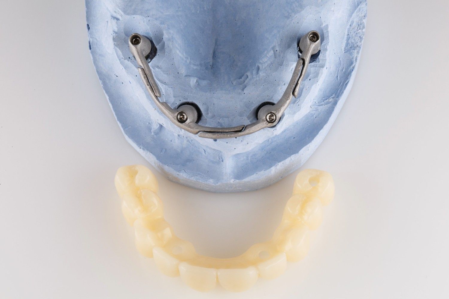 Molde dental azul con alambres metálicos sobre un alineador dental amarillo translúcido.
