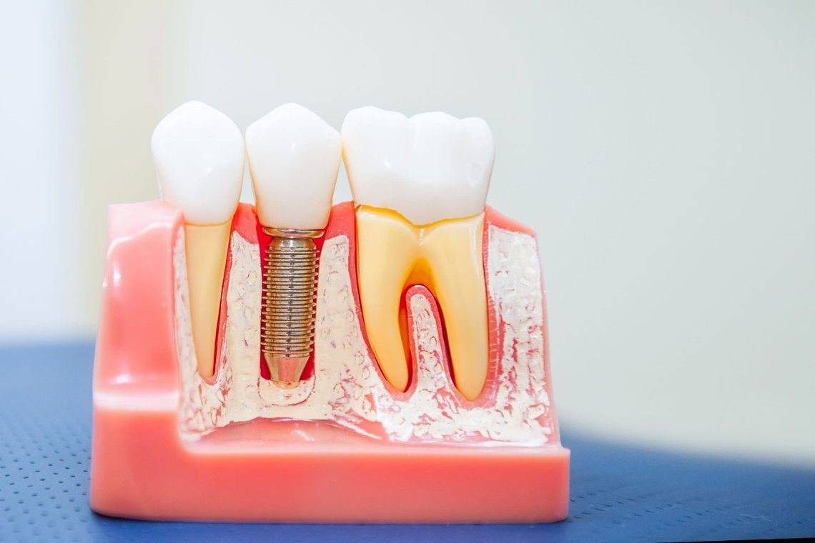 Modelo de implante dental que muestra un implante de titanio y dos coronas dentales en tejido gingival rosado.